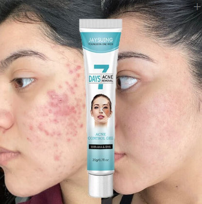 CREMA TRATAMIENTO ELIMINA ACNE - MASCARILLA FACIAL QUITA BARROS